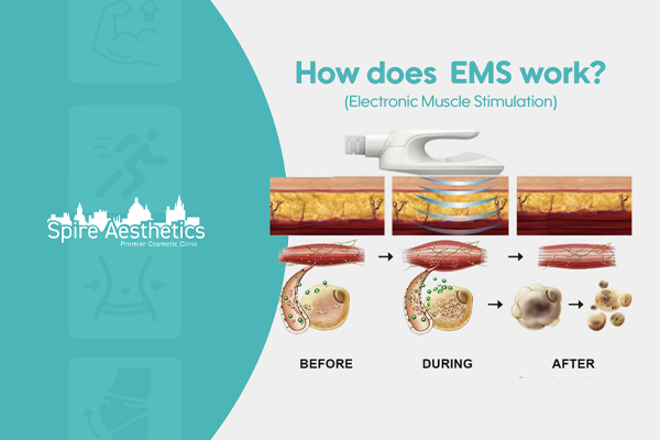 EMS treatment for post pregnancy weight loss treatment Newham