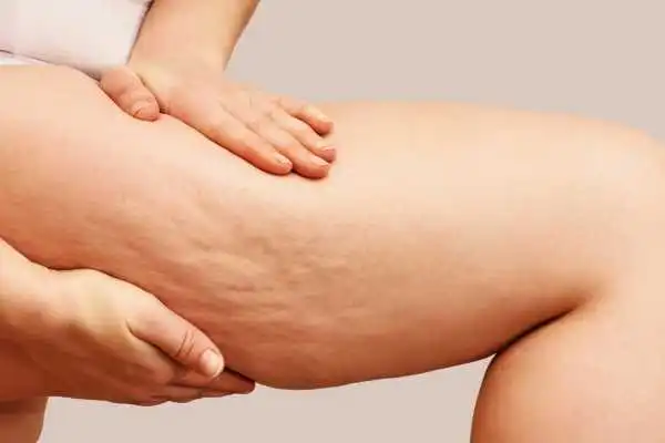 Image of woman showing leg with cellulite Newham
