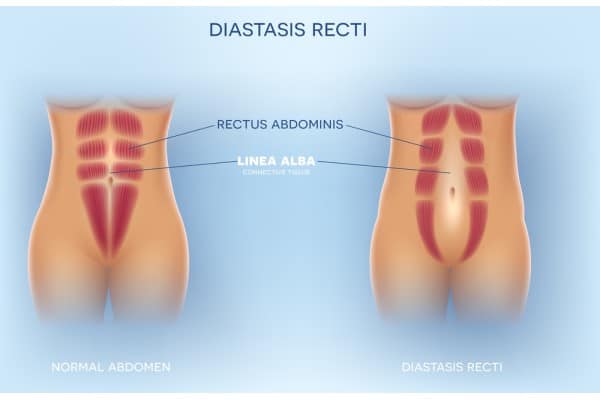 What Non-Surgical Options Are Available for Diastasis Recti Newham?