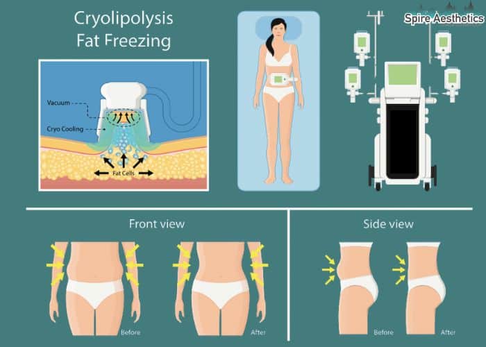 Image of diet and fat freezing combined for best results for Spire Aesthetics Newham