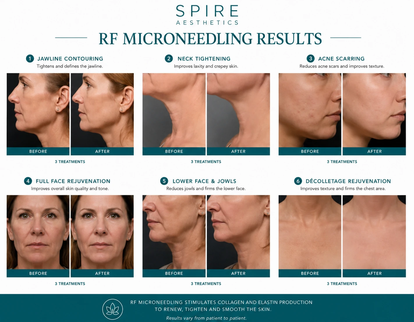 RF Microneedling Skin tightening Newham results