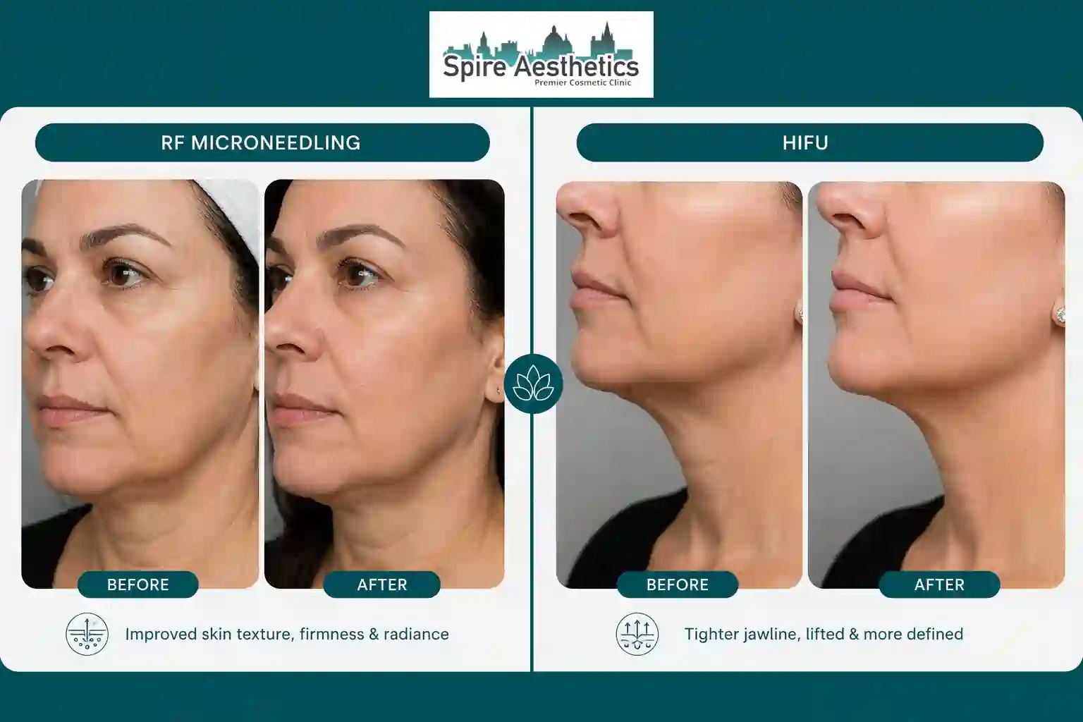 Can RF Microneedling and HIFU Be Combined Newham?