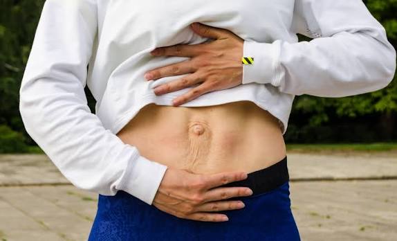 When Could Diastasis Recti Be the Missing Piece of the Puzzle Newham?