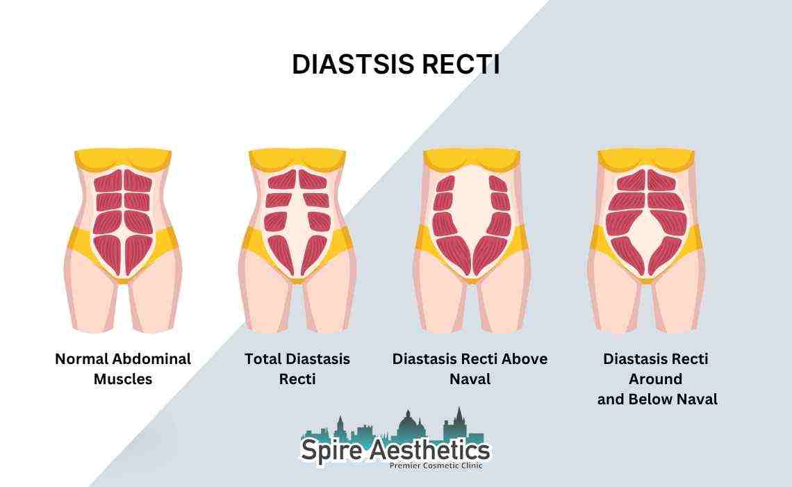 Is Non-Surgical Diastasis Recti Treatment Right for You? Common Concerns Answered Newham